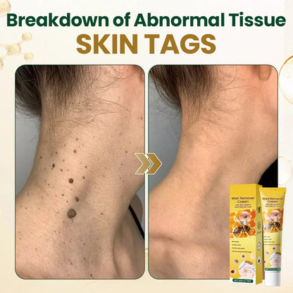 Alcuras® Wart Remover Cream with Bee Venom and Salicylic Acid – Skin Tag Removal & Skin Repair Formula for Face and Body