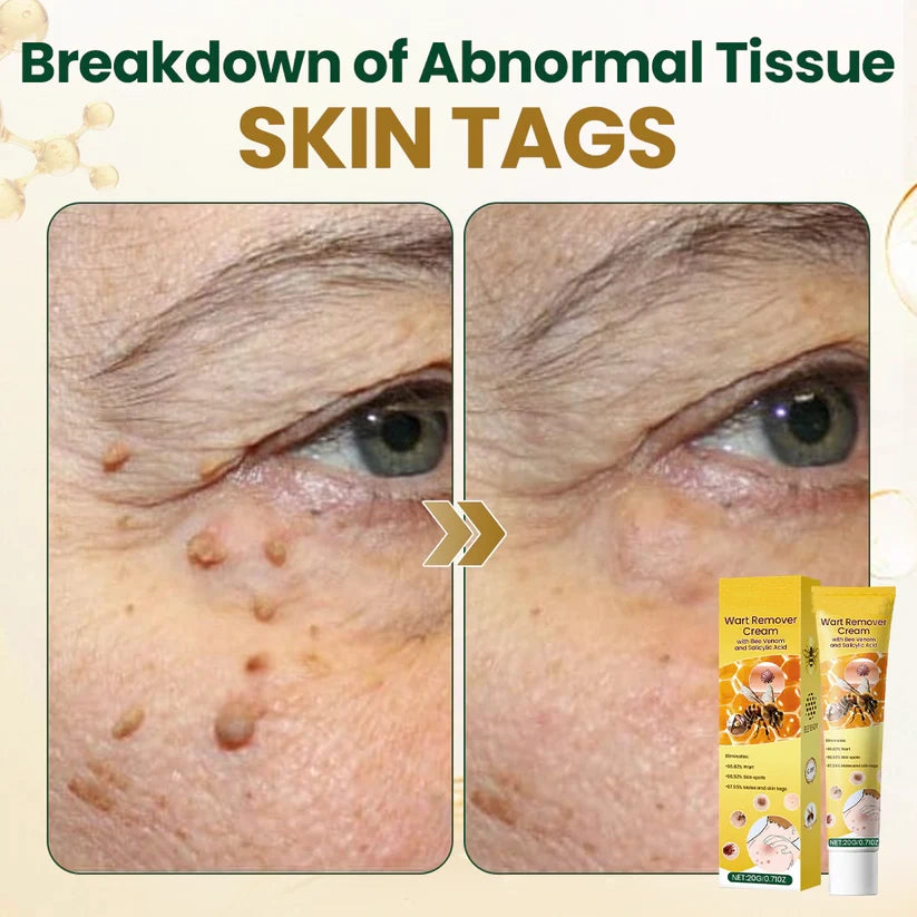 Alcuras® Wart Remover Cream with Bee Venom and Salicylic Acid – Skin Tag Removal & Skin Repair Formula for Face and Body