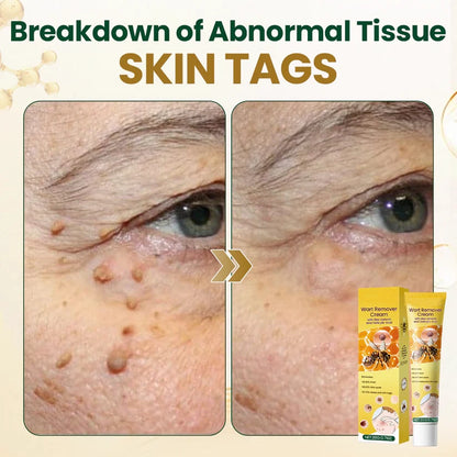 Alcuras® Wart Remover Cream with Bee Venom and Salicylic Acid – Skin Tag Removal & Skin Repair Formula for Face and Body