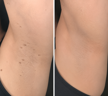 Alcuras® 2-in-1 Microneedle & Hydrocolloid Patch
