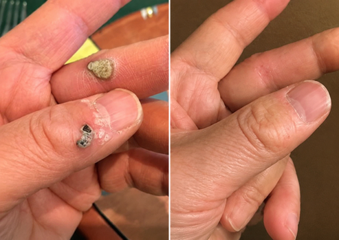 Alcuras® 2-in-1 Microneedle & Hydrocolloid Patch